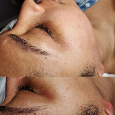 Before & After ::. Signature Detox with Dermaplane Facial