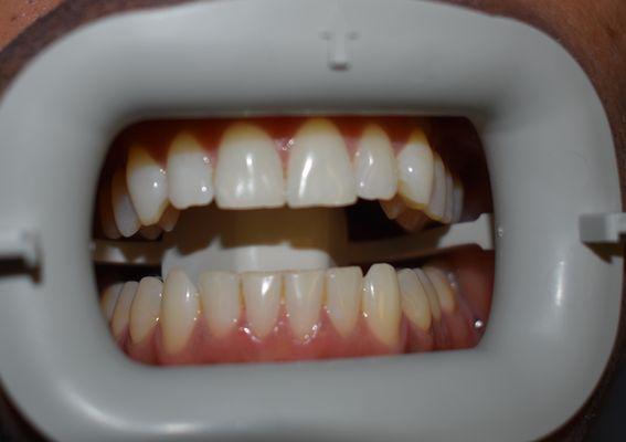 Before whitening