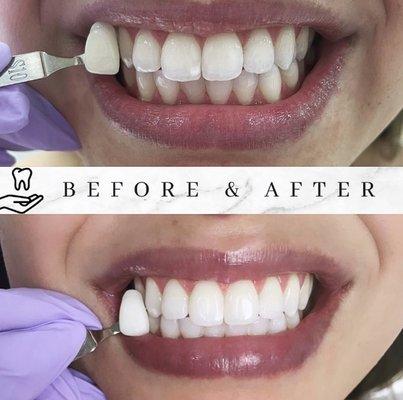 Professional teeth whitening, same days results. Pain free