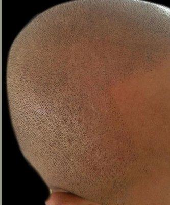 Scalp Micropigmentation, creating hair lines, head tattoo