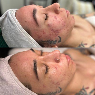 Before & After 
 client came in with cystic Acne & scaring these are results after just 3 sessions of Hydrofacial & LED Therapy