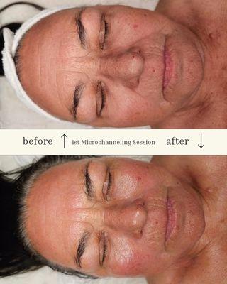 Microchanneling Treatment to minimize fine lines and wrinkles, pores, acne scars, and brighten skin tone