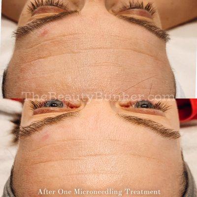 1 Microneedling MD Pen Treatment