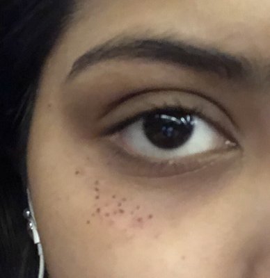 A day after treatment (looks like little freckles)