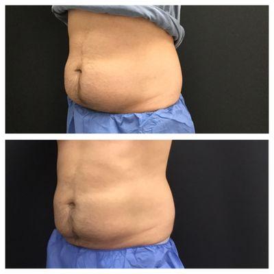 Before and after CoolSculpting to the lower abdomen