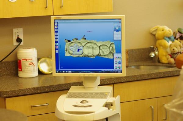 CEREC-One Visit Crowns-No Temporaries, No Second Visits