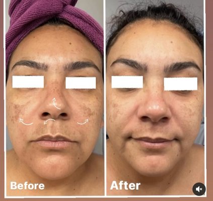 Hyperpigmentation significantly reduced after chemical peel