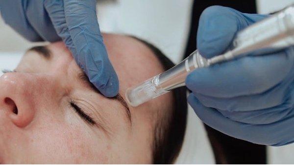 Microneedling