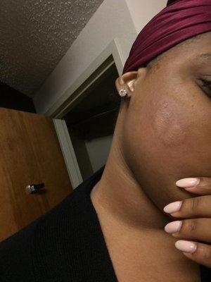 AN ALLERGIC REACTION TO A BED BUG BITE