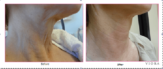 Viora Reaction RF Skin Tightening Neck