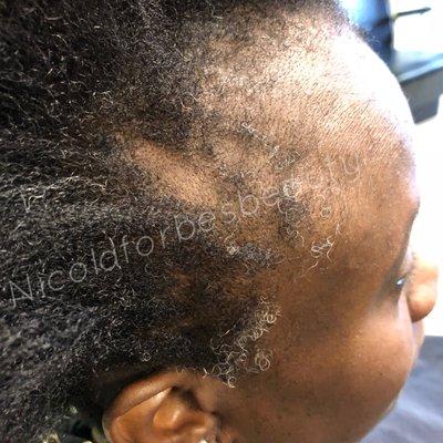 Traction Alopecia  we were able to stabilize and regrow some of her hair