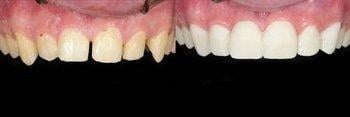 Veneers Before and After