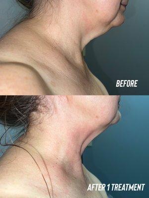 Result of 1 CryoToning Neck Firming Session