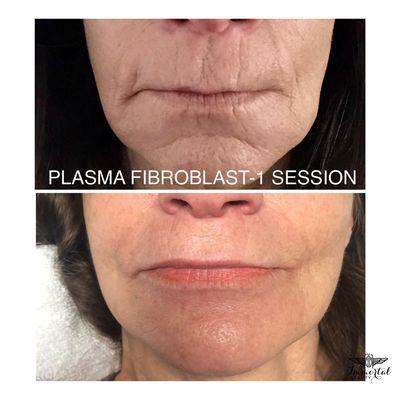 Plasma Fibroblast Before & After 1 Session