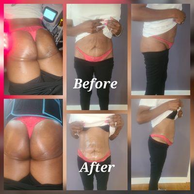 Non-Invasive Lipo Cavitation And BBL