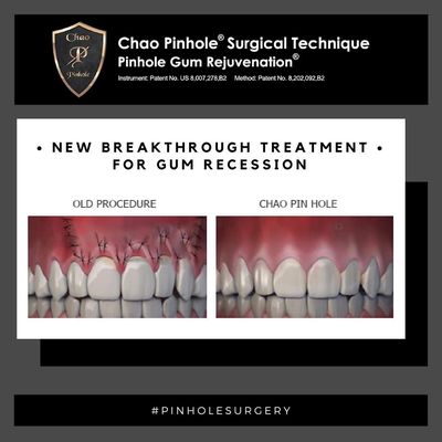 Gum receding? FREE CONSULTATION FOR PINHOLE SURGERY. Faster recovery time & less invasive.