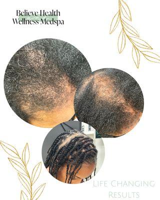 Life Changing Results! Adding a protective style to reduce breakage and prevent more damage.