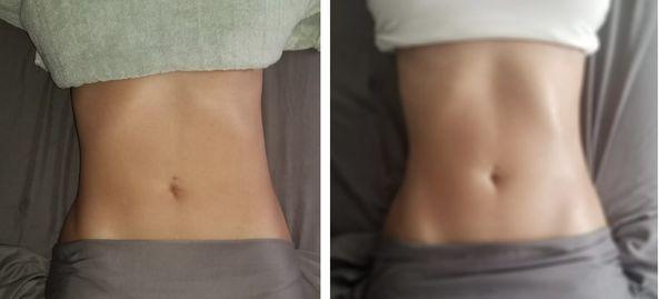 Results From one Slimming sculpting lymphatic drainage session