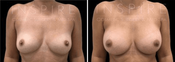 Breast Augmentation Before & After