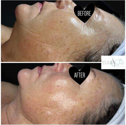 Age Refinement HydraFacial