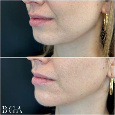 Before & After - Chin Filler - Lower Face Enhancement