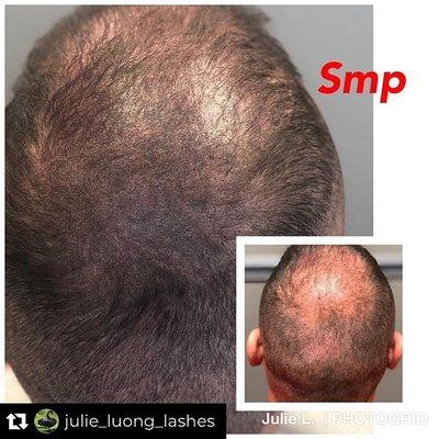 Scalp Micro-pigmentation [SMP] is a non-invasive treatment creating the appearance of tiny hair follicles.