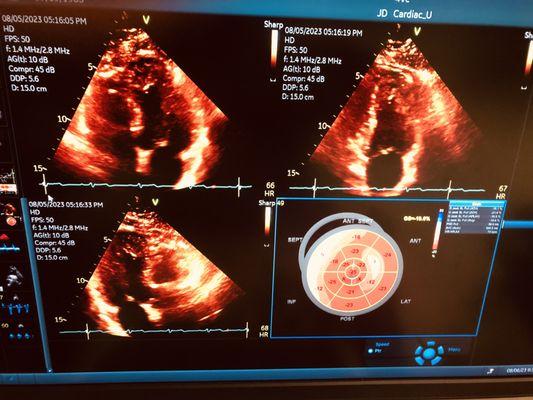 Strain imaging