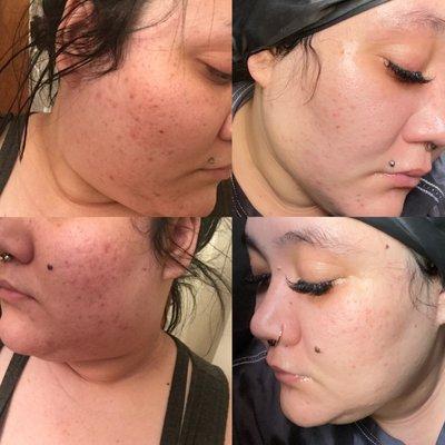 Obagi Medical Acne line results.   Call us for your skincare needs.