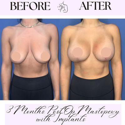 Mastopexy with implants by Dr. Michelle Cabret at The Cosmetic Center in Scottsdale AZ