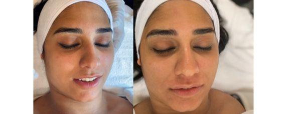 Before and after just one customized treatment of PCA skin sensi peel.