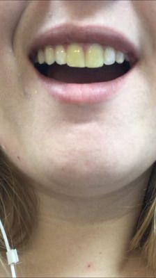 Temporary veneers that "weren't yellow" per the dental assistant.