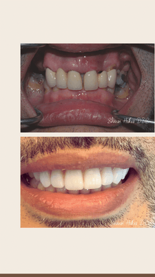 All on 4 dental implants, permanent dentures, Full mouth dental implants, smile makeover, dental implants