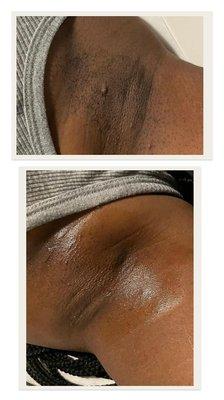 Before and After of an Underarm Wax