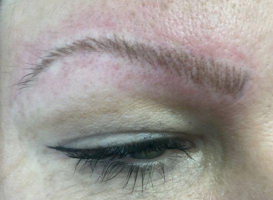 After permanent eyebrow procedure using individual hairstroke technique