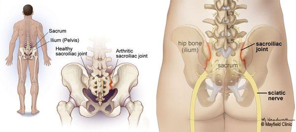 A sacroiliac joint injection is used to diagnose or treat lower back pain that comes from your sacroiliac joint.