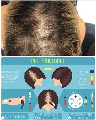 Hair Loss Treatment