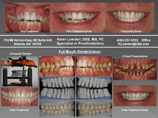 Full Mouth Reconstruction