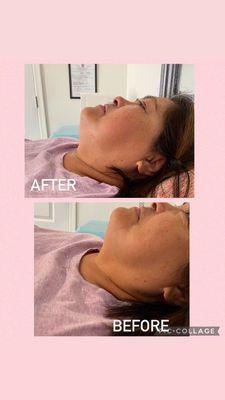 Facial Contouring/Sculpting