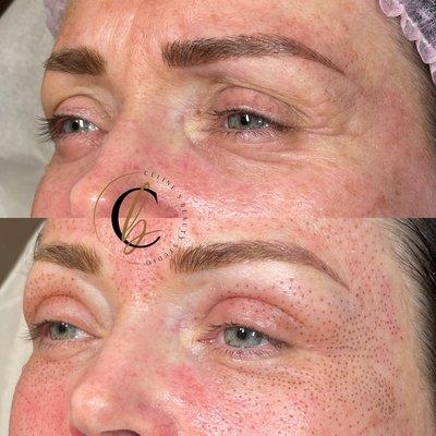 Fibroblast skin tightening - immediate results seen on and around eye area.