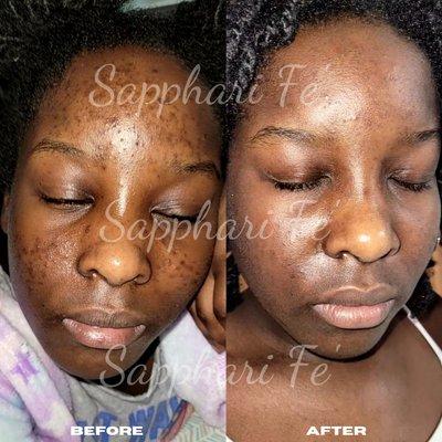 Acne & Hyperpigmentation Treatment (2months)