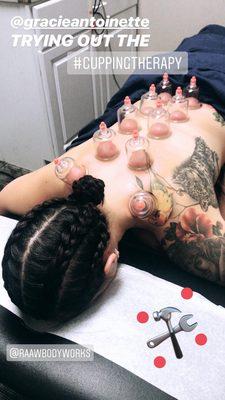 Cupping Therapy