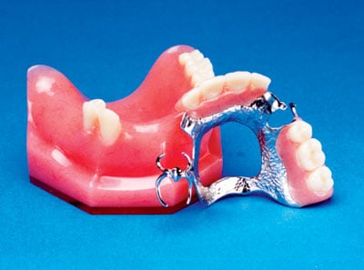 Partial Denture with Metal Framework