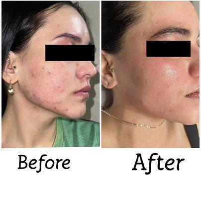 before & after of client who struggled with inflamed breakouts