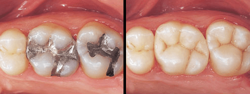 Composite Fillings