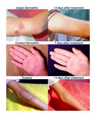 Comparison of skin diseases before and after treatment