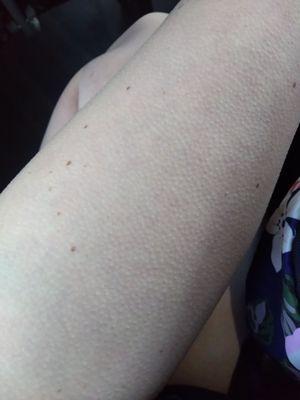 Goosebumps from the bus being so cold