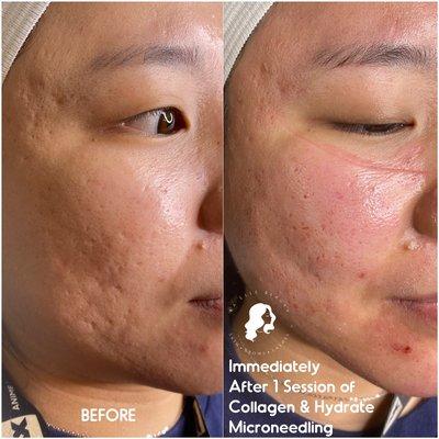 Amazing results IMMEDIATELY after 1st Collagen & Hydrate Microneedling Treatment