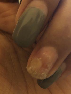 NAIL INFECTION