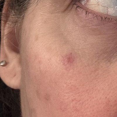 Permanently scarred after a facial. Aesthetician tried to extract something that wasn't there.