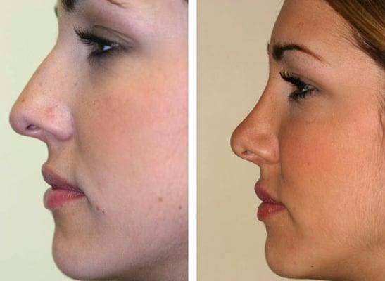 rhinoplasty